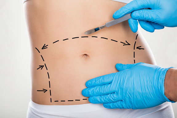 Abdominoplastik Regensburg